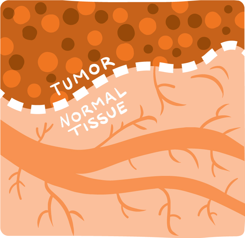 Illustration showing a clear line between tumor tissue and normal tissue.