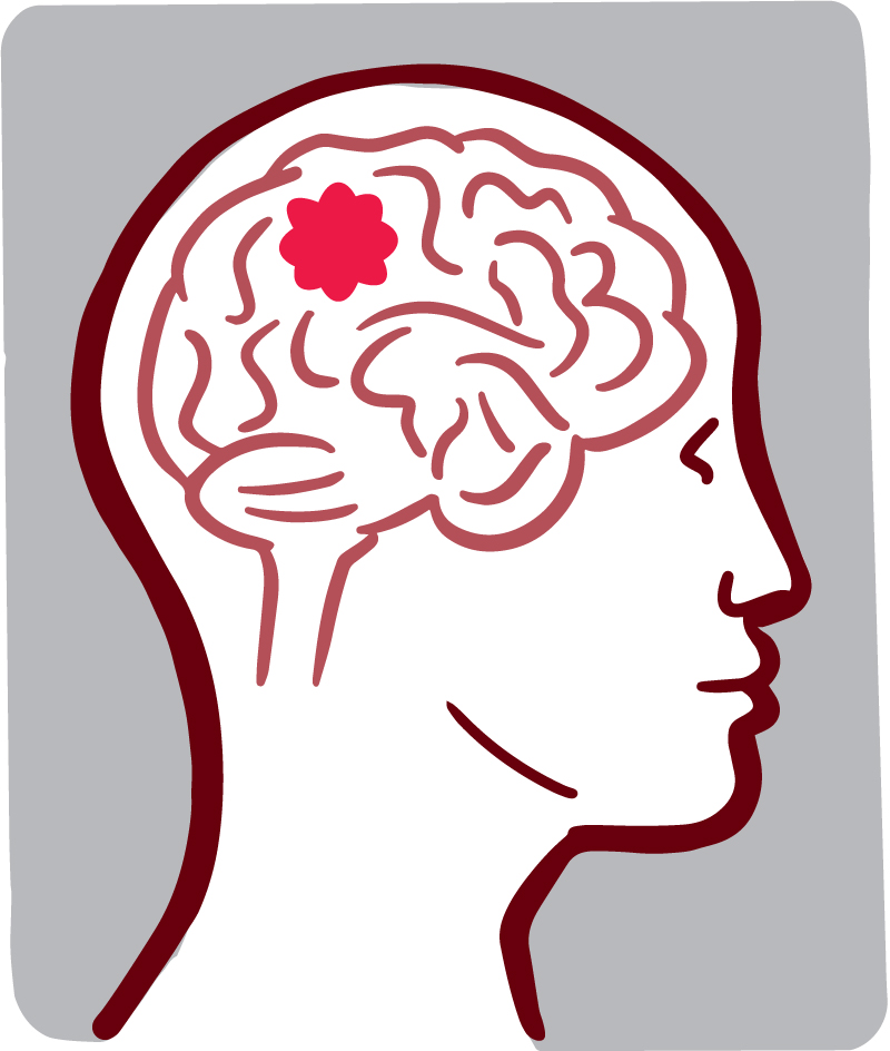 Illustration of a brain tumor.