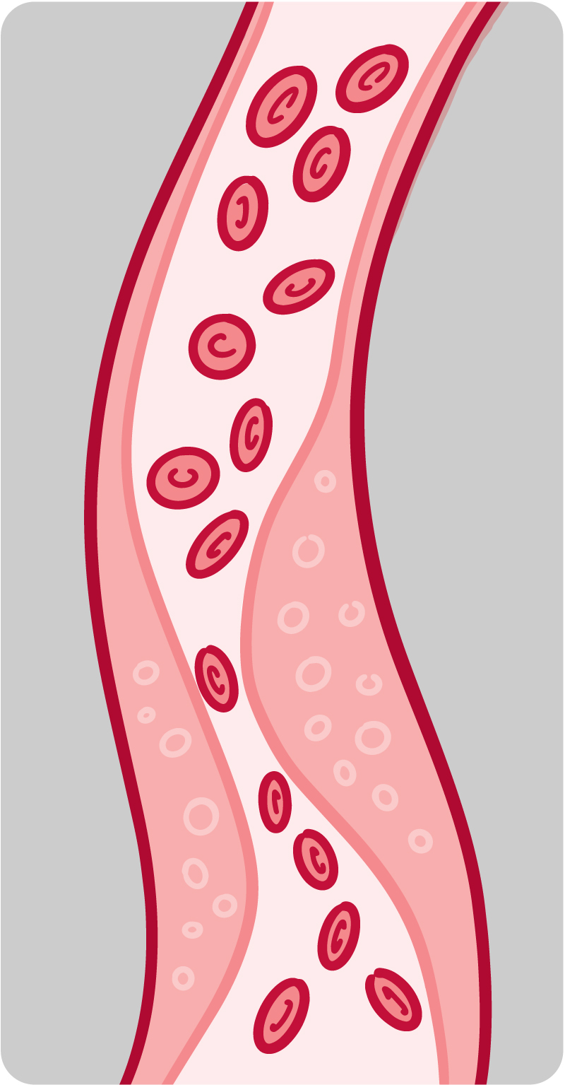 Illustration of a blood vessel with plaque buildup